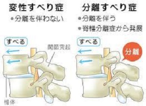 脊椎分離症症